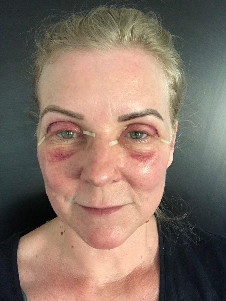 Oberlidstraffung Mein Erfahrungsbericht erbsünde Schnittmuster zum