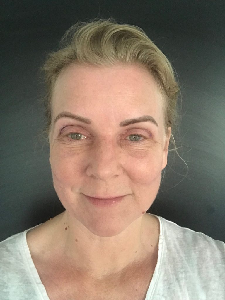 Oberlidstraffung Mein Erfahrungsbericht erbsünde Schnittmuster zum